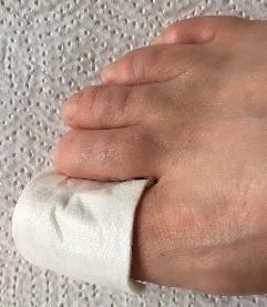 Big toe with Melolite dressing on