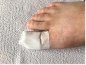 Big toe with Softpore dressing on, attached with surgical tape
